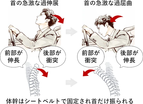 むちうちの受傷機転